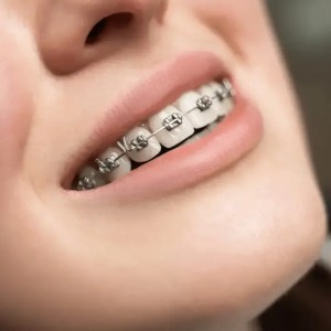 mejor dentista en miami, carillas de porcelana en miami, Botox miami, costo del tratamiento de conducto en miami, elevación de seno nasal en miami, mejores carillas en miami, mejor dentista del sur de florida, mejor dentista cosmético en miami, mejor atención dental en miami, sage dental