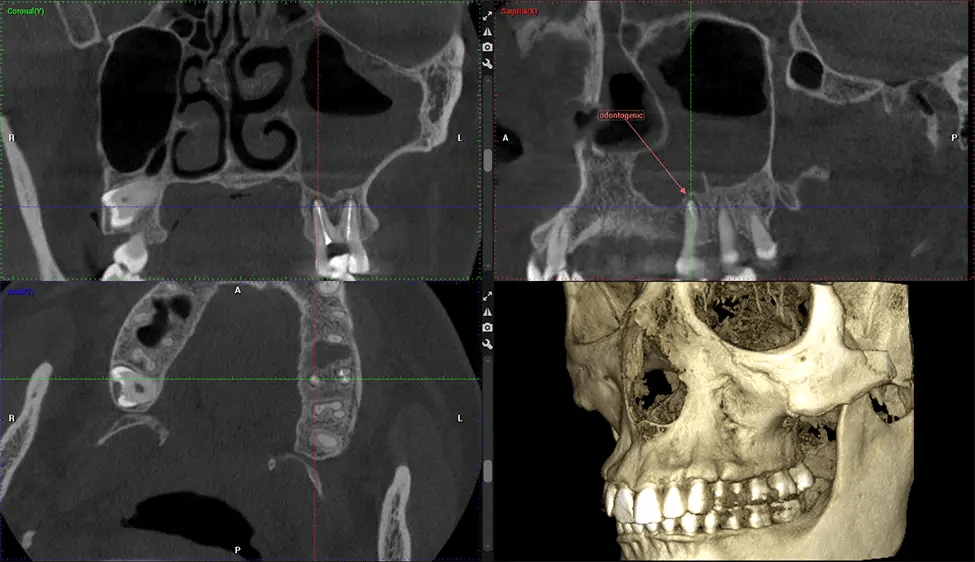 Planmeca CBCT Low Radiation G7 Sinus Study